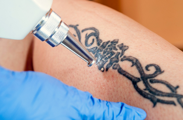 laser tattoo removal